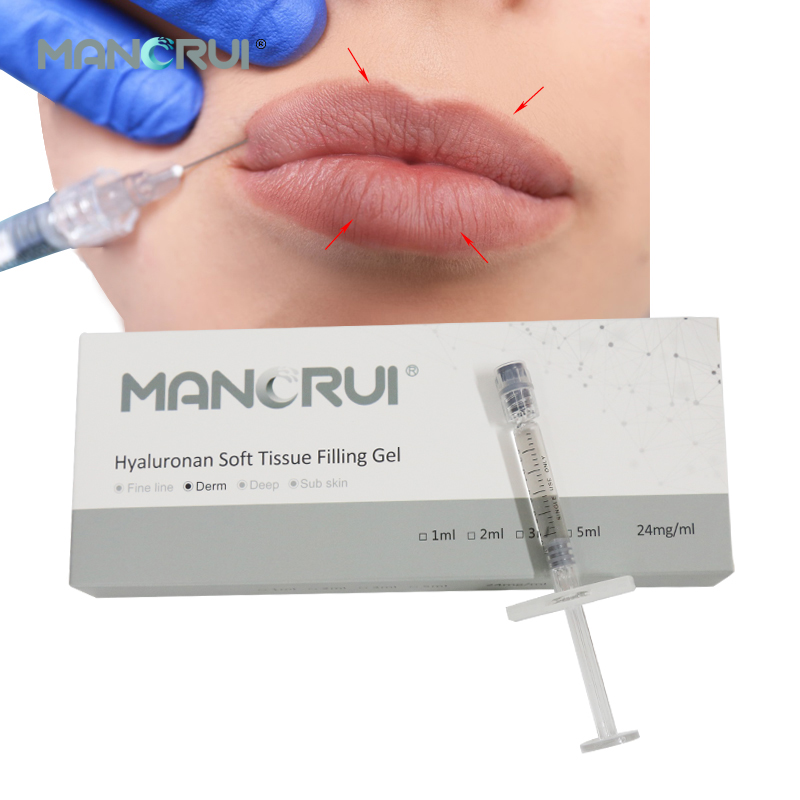 Derm 1ml Cross Linked Hyaluronic Acid Filler Lip Filler, Natural lip plumping effect.,  for Marionette Line, Glabella lines (frown lines) , Mid-depth smile lines,Moderate nasolabial folds,  Cheek contour wrinkles