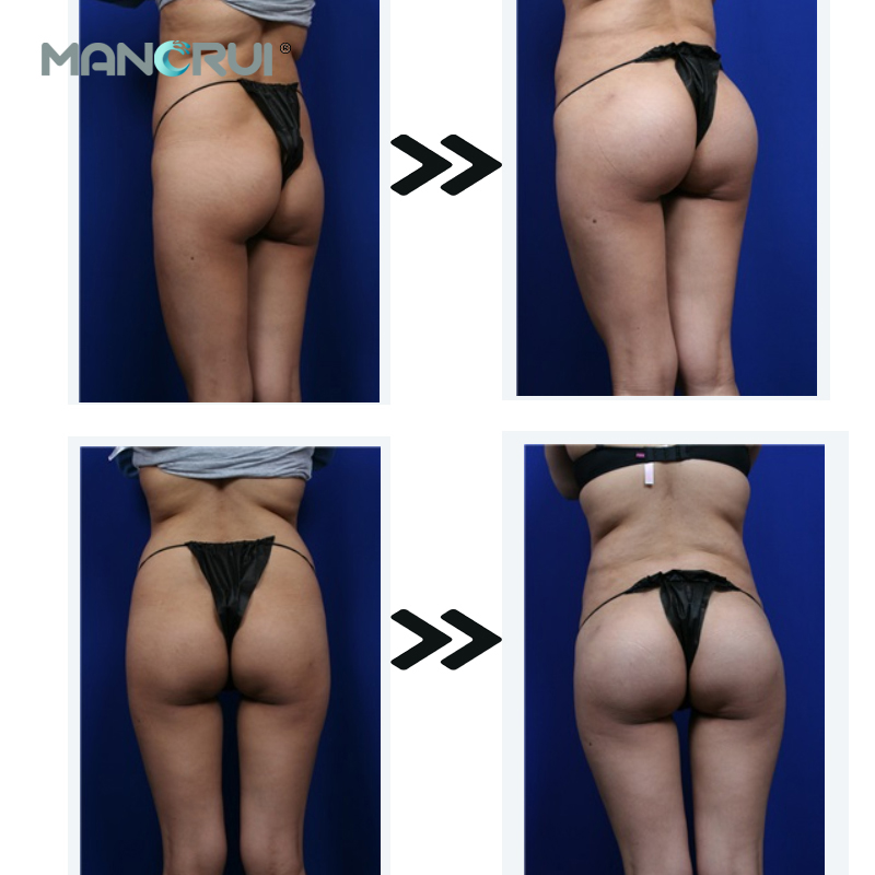 20ml breast hip enlargement buttock injection cross linked hyaluronic acid dermal filler for buttock