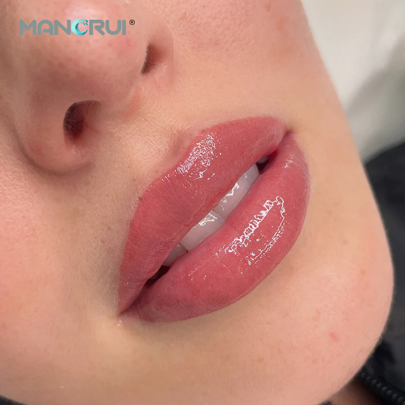 Cross Linked Hyaluronic Acid Filler Derm 2ml Lip Filler, Normal lip plumping effect., for Marionette Line, Glabella lines (frown lines) , Mid-depth smile lines