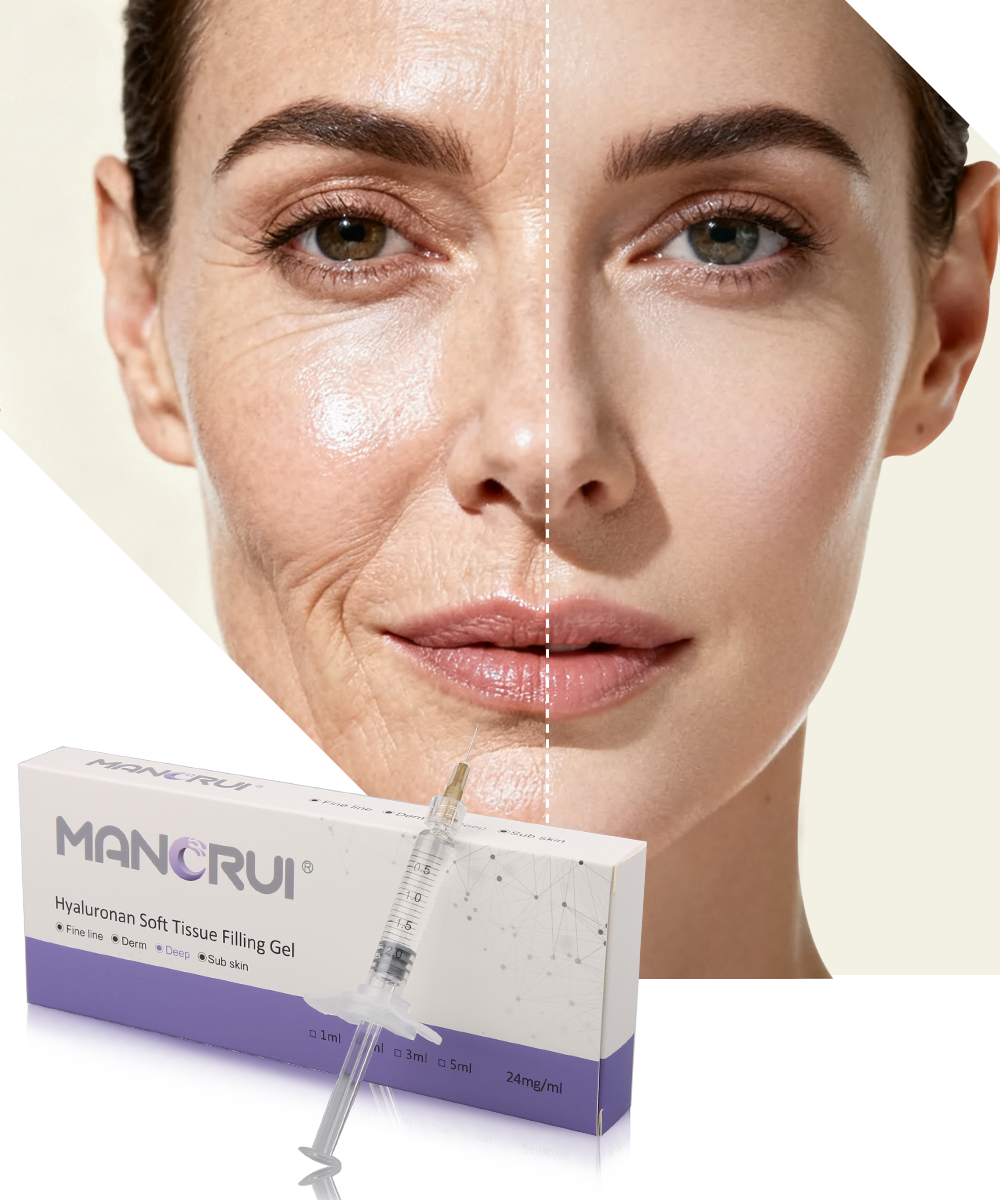 Deep 2ml Cross Linked Hyaluronic Acid Filler for Deep wrinkles and lines, Nasolabial folds, Marionette lines, Forehead wrinkles, Chin contour, Nose shape
